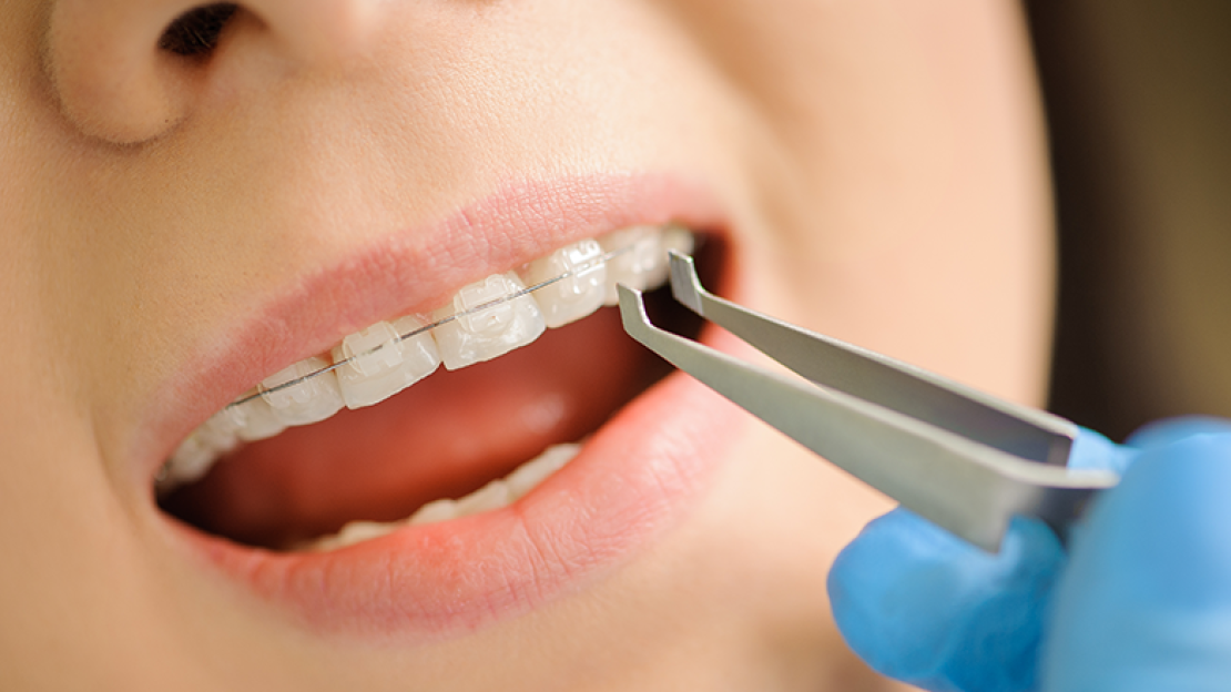 Mennyibe is kerül a szép mosoly? - Fogszabályozás árak