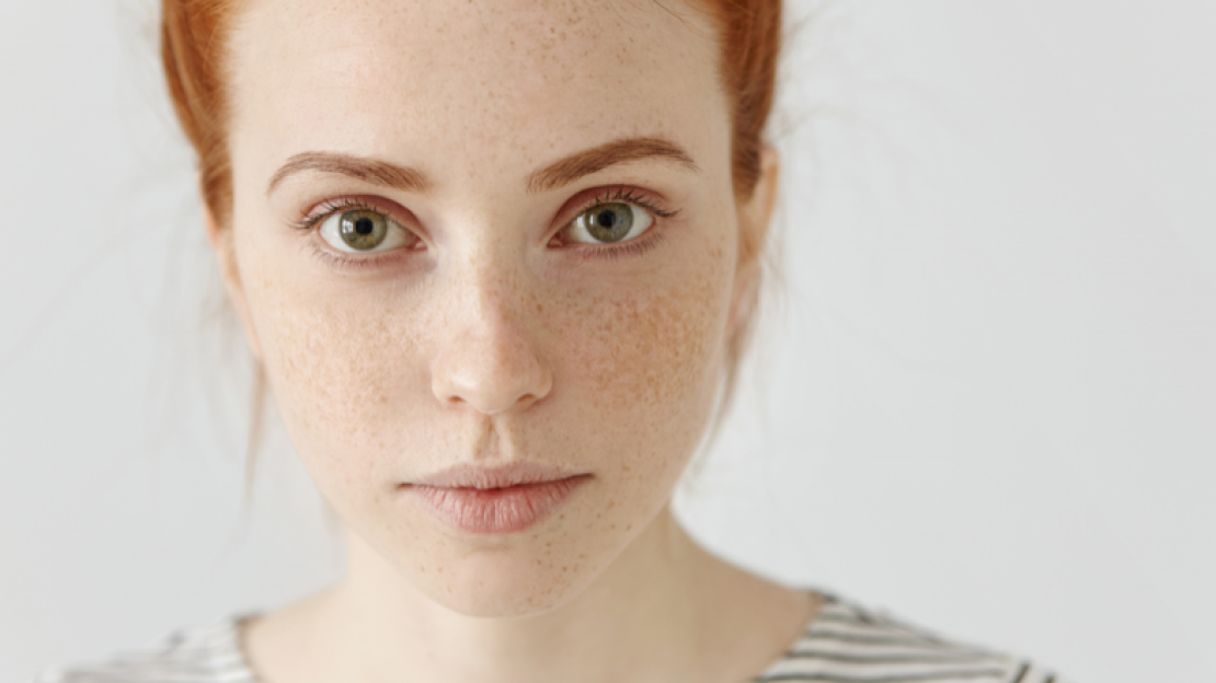 A nyár előhozta a pigmentfoltjaid? Segítünk eltüntetni!