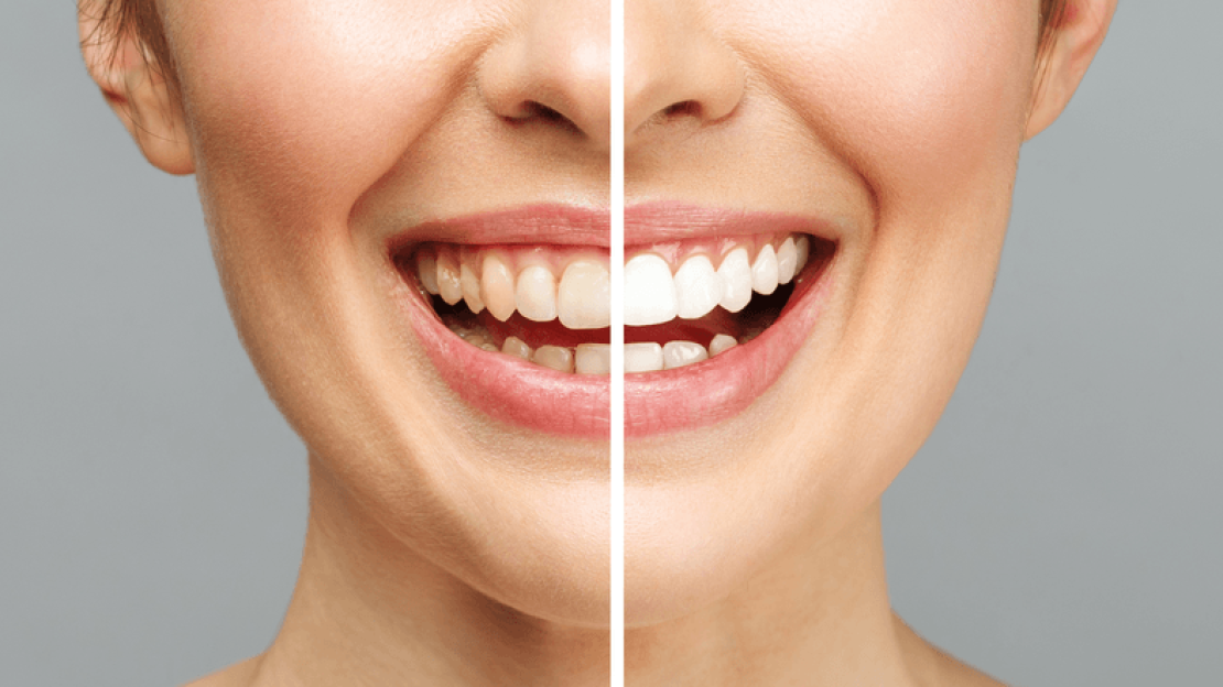 Ajándékozz hófehér, gyönyörű mosolyt idén Karácsonyra!