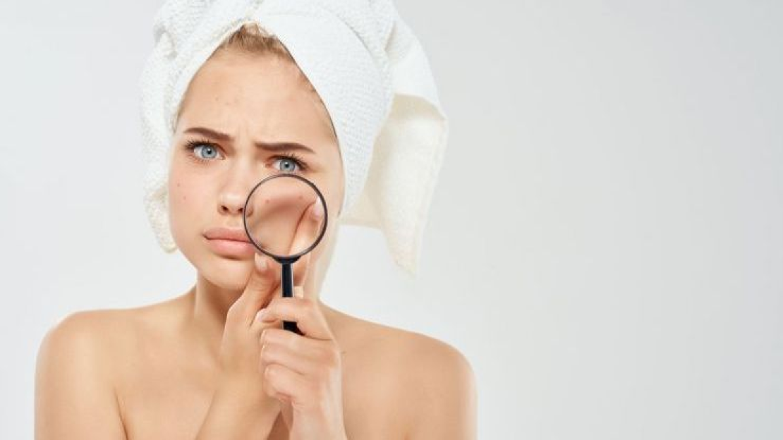 Kozmetikai megoldások pattanások ellen