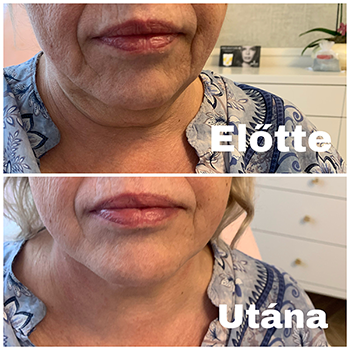 Bioszálas arcfelvarrás ár Budapest