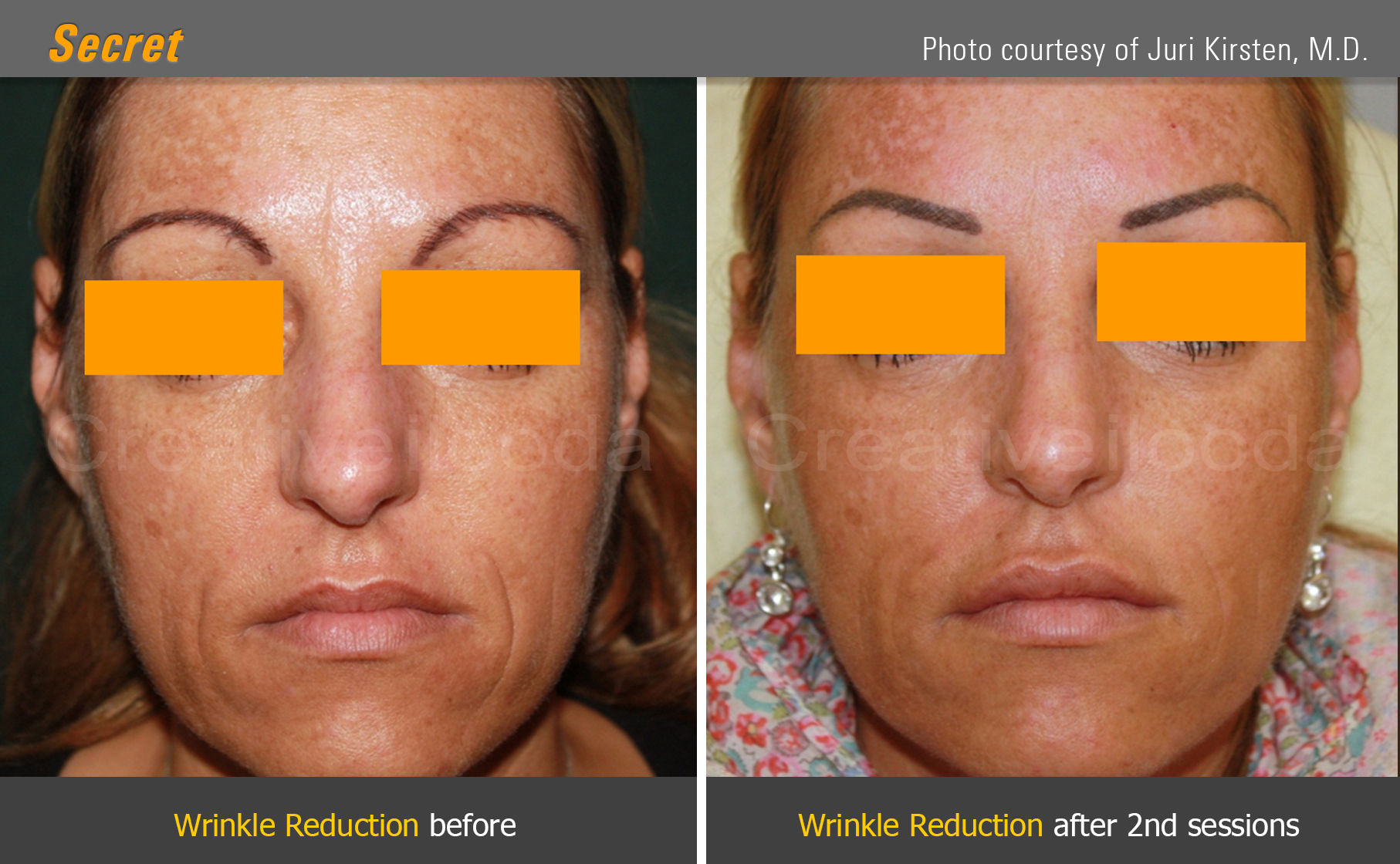 látványosan kevesebb finom ránc