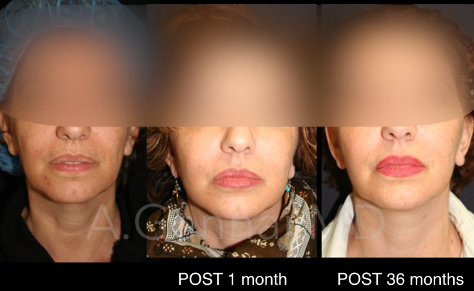 ráncfeltöltés arcfeltöltés saját zsírral vélemények