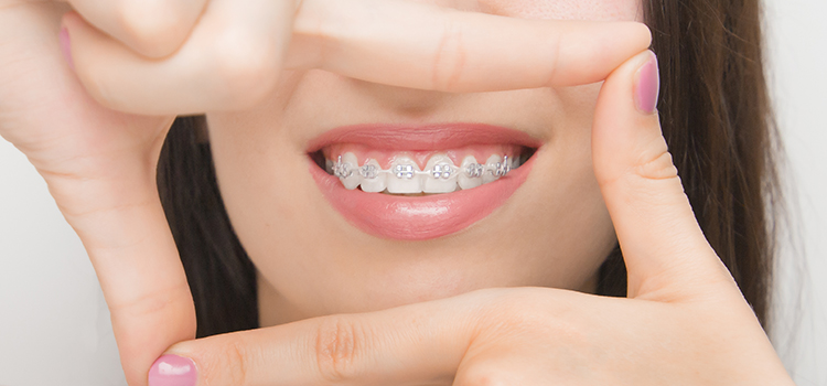 damon fogszabályozó