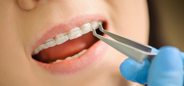 damon fogszabályozó