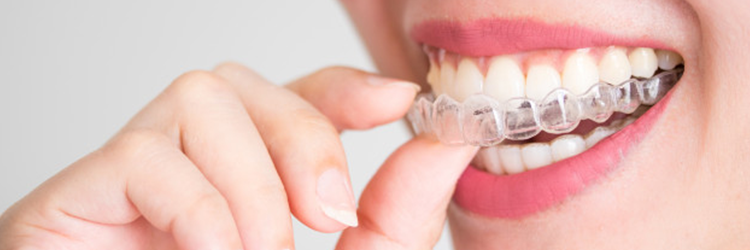 láthatatlan fogszabályozó könnyű tisztítással