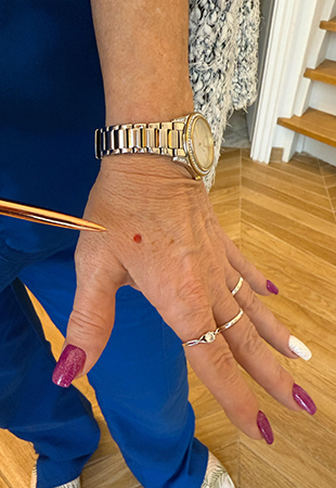 QI derm pont dermal piercing